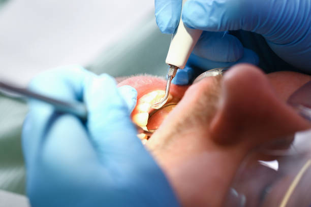 Best Emergency Root Canal Treatment in Altoona, PA