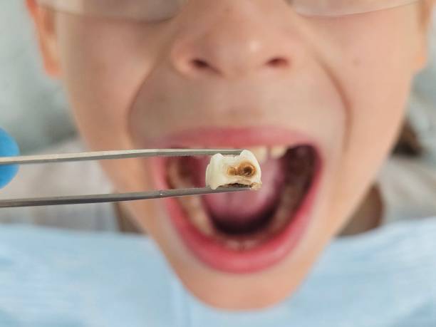 Best Broken or Cracked Tooth Emergency Dentist in Altoona, PA